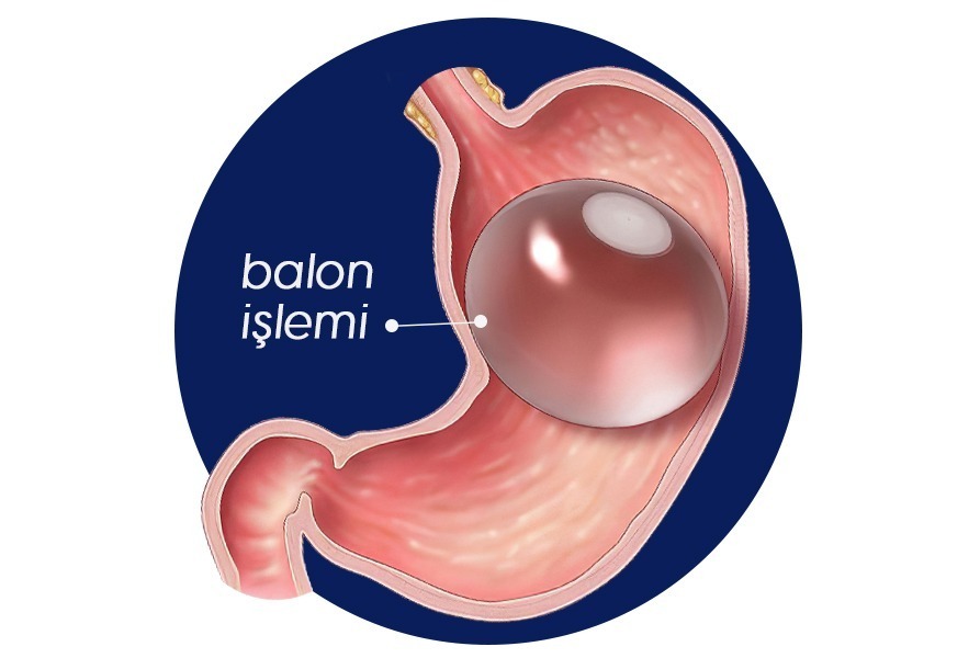 Mide balonu taktıranlar adlı görsel