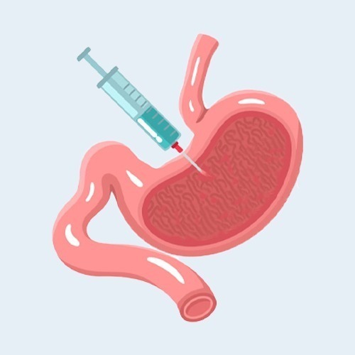 mide botoksu mu mide balonu mu karşılaştırması için mideye botoks uygulamasını gösteren tıbbi çizim