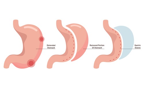 Tüp mide ameliyatı sürecinde midenin küçültülmesini gösteren üç aşamalı ilustrasyon.