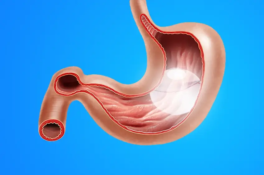 Mide içinde yerleştirilmiş yutulabilir mide balonu illustrasyonu.