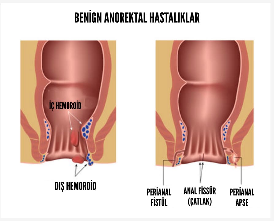 Benign Anorektal Hastalıklar