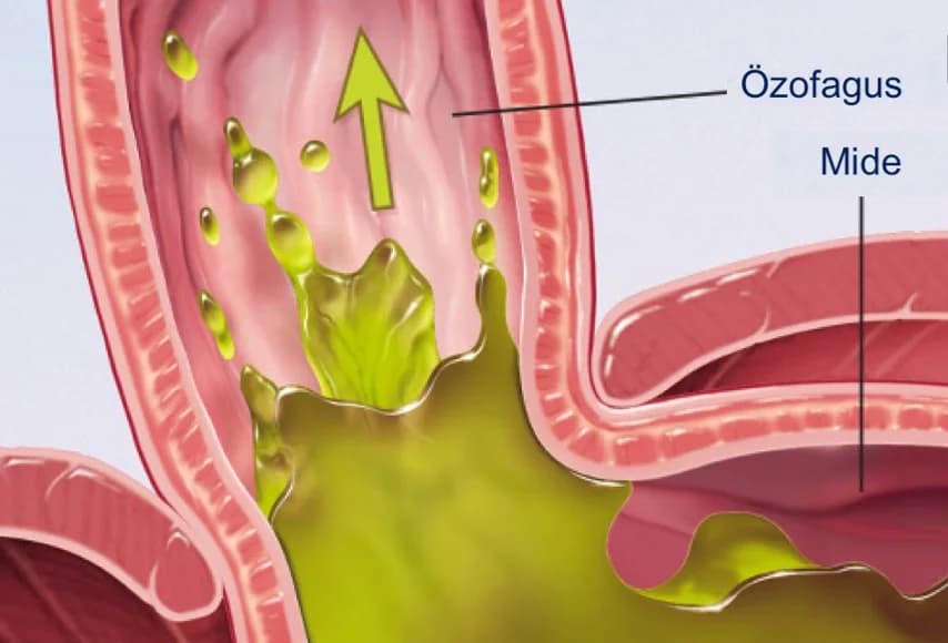 Gastroösefageal Reflü Hastalığı