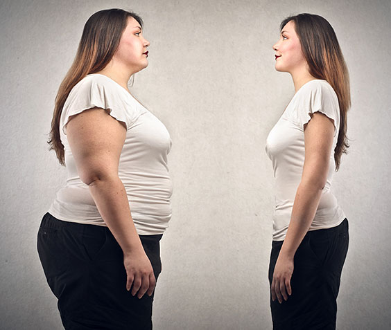 tüp mide operasyonunu anlatan öncesi ve sonrası görüntüsü