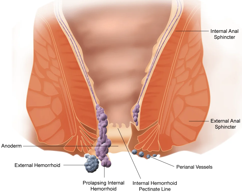 Basur neden olur sorusunu açıklayan hemoroid anatomisi; iç hemoroid, dış hemoroid, anal sfinkter ve damar yapılarının detaylı gösterimi.