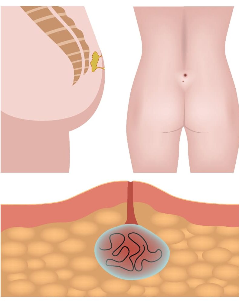 Kıl dönmesi fenol tedavisi sürecinde sinüs yapısının anatomik görünümü ve pilonidal sinüs tüneli