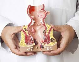 Makat çatlağı belirtileri ve anal bölge anatomisini gösteren tıbbi model; anal fissür oluşumu ve anüs çevresi yapılarının demonstrasyonu.