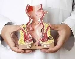 Makat çatlağı belirtileri ve anal bölge anatomisini gösteren tıbbi model; anal fissür oluşumu ve anüs çevresi yapılarının demonstrasyonu.