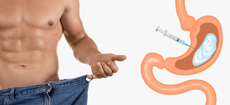 Mide botoksu işlemi sırasında mide duvarına botulinum toksini enjekte edilmesini gösteren görsel.