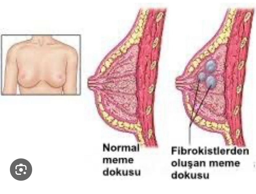 Meme Kanseri Belirtileri: Kendi Kendine Muayene Nasıl Yapılır?
