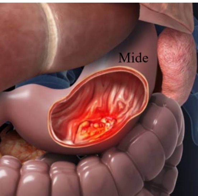 Mide Kanseri Risk Faktörleri ve Korunma Yolları