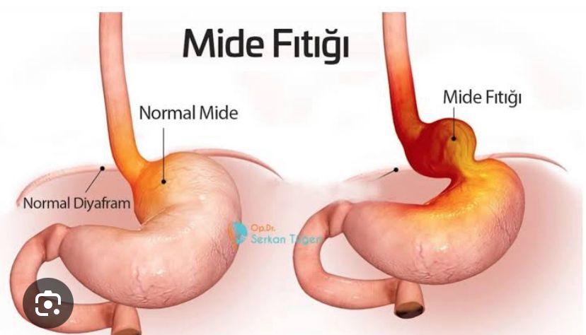 Göbek Fıtığı Neden Olur? Ameliyatsız Geçer mi? | Doç. Dr. Hüseyin Eken