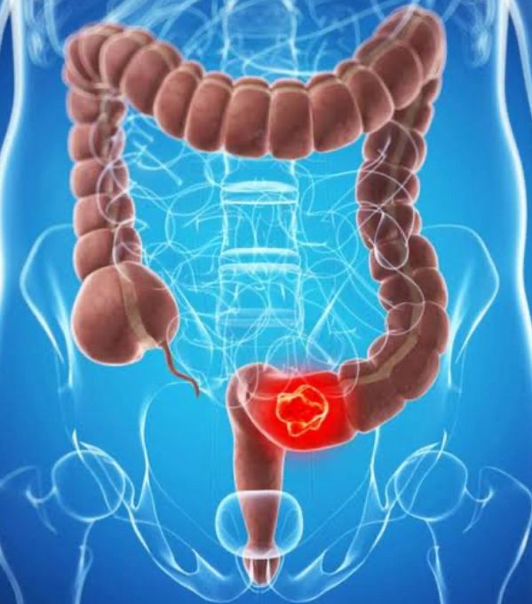 Kolon Kanseri Belirtileri Nelerdir? Erken Tanının Önemi | Doç. Dr. Hüseyin Eken