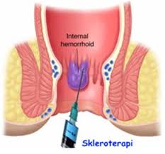 Hemoroid (Basur) Tedavisi İzmir | Ameliyatsız ve Cerrahi | Doç. Dr. Hüseyin Eken