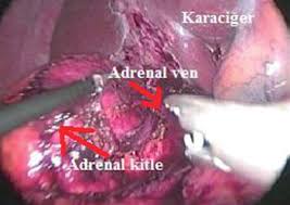 Cushing Sendromu ve Adrenal Bez Cerrahisi