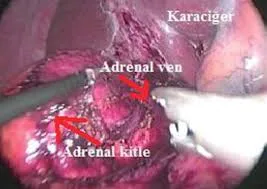 Cushing Sendromu ve Adrenal Bez Cerrahisi