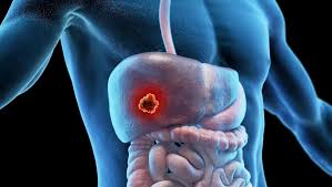 İzmir'de karaciğer yağlanması, hepatit, siroz ve karaciğer kanseri için multidisipliner tedavi. Cerrahi, obezite cerrahisi ile karaciğer yağlanması tedavisi ve takip.