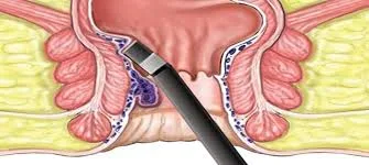Anal Fistül Tedavisi İzmir | Lazer, LIFT, Seton | Doç. Dr. Hüseyin Eken
